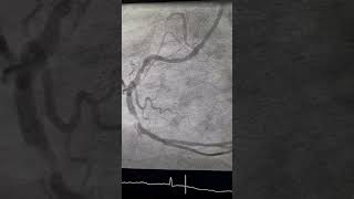 inf MI  coronary angiography and PCI [upl. by Araccat]