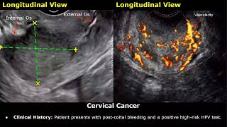 Cervix Ultrasound Reporting  Nabothian Cysts Polyp Fibroid Cervical Incompetence Cancer USG [upl. by Kaazi]