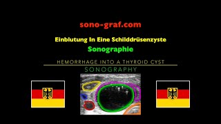 Sonographie  Einblutung In Eine Schilddrüsenzyste [upl. by Swanson]