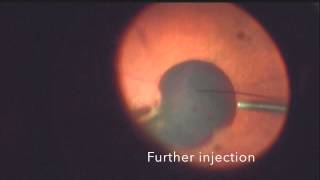 Submacular Tpa for large sub macular bleed in wet AMD [upl. by Attekahs376]