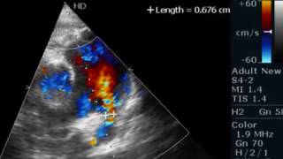 PDA  ECHOCARDIOGRAPHY SERIES BY DR ANKUR K CHAUDHARI [upl. by Combes972]