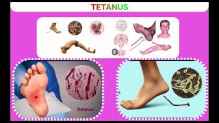 Tetanus  تشنج  धनुस्तंभ [upl. by Einiffit]