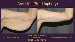 Arm Lifts Brachioplasty SF Bay Area [upl. by Morey487]