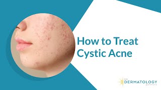 How to Treat Cystic Acne [upl. by Akirehs]