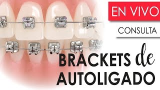 BRACKETS DE AUTOLIGADO  CONSULTORIO VIRTUAL RESOLVIENDO TUS DUDAS [upl. by Klingel]