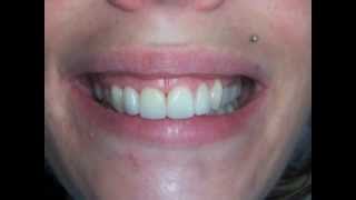 Sourire gingival et facettes dentaires [upl. by Stenger]