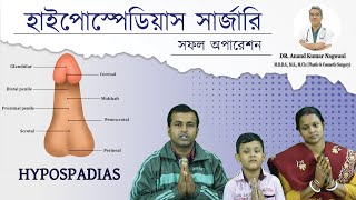 Hypospadias  প্রস্রাব সঠিক জায়গায় না খোলার সমস্যা  Hypospadias Repair in India  Dr Nagwani [upl. by Eleirbag844]