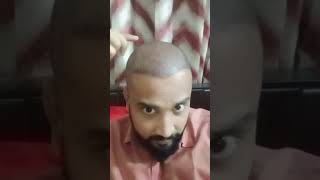 2nd day after hair transplant in Bangladesh [upl. by Pettifer]