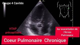 Coeur Pulmonaire Chronique HTAP Précapillaire Échographie [upl. by Leahcym613]