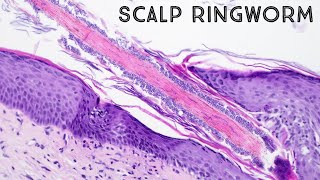 Ringworm under microscope hair follicle fungus in scalp aka tinea capitis pathology dermpath [upl. by Hillier]