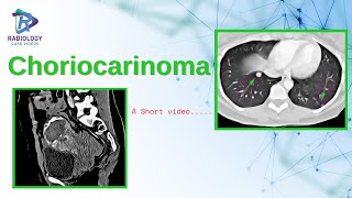 Choriocarcinoma Umamaheshwar Reddy V [upl. by Debor100]