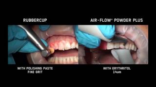 AIRFLOW® VS Rubber cups [upl. by Baggett466]