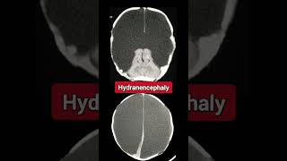 Hydranencephaly  Radiology [upl. by Martijn467]