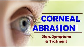 corneal abrasion Hindi [upl. by Badger]