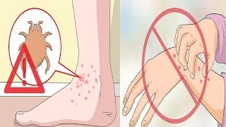 Common Causes and Treatments for Itchy Palm [upl. by Einnoj613]