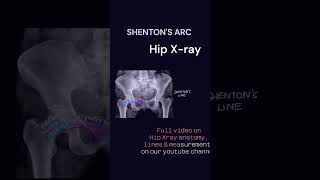 Shentons arc hip Xray anatomy neet radiology radiographyxray orthopaedics pediatrics [upl. by Gide]