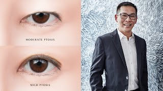 Ptosis Correction for Droopy Eyelids  Dream Aesthetics amp Plastic Surgery [upl. by Maryjo]