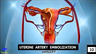 Uterine Artery Embolization  Tumor Cell Removing Surgery [upl. by Sower]