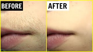 पाएं अनचाहे बालों से छुटकारा  Permanent Hair Removal  Anaysa [upl. by Ainoek]