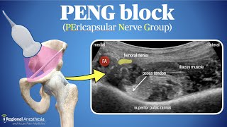 PENG Block Pericapsular Nerve Group Block [upl. by Hsetirp]