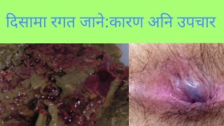 Piles in nepali doctor sathi Dr Abhijeet Thakur [upl. by Eadith]