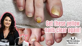 Pedicure Transformation on Yellow Toenails [upl. by Auohs]