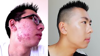 HOW TO COVER UP ACNE  MENS MAKEUP [upl. by Atsahc27]