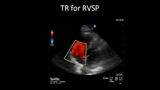 Principles of Doppler Ultrasound [upl. by Odnalro]