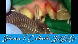 Prepping Posterior Teeth for Crowns  Dental Minute with Steven T Cutbirth DDS [upl. by Yojal849]