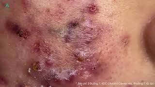 Big Cystic Acne Blackheads Extraction Blackheads amp Milia Whiteheads Removal Pimple Popping [upl. by Malha373]