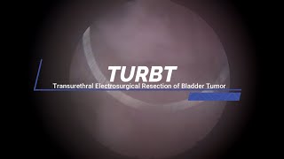 TURBT  Transurethral Electrosurgical Resection of Bladder Tumor [upl. by Kylander]