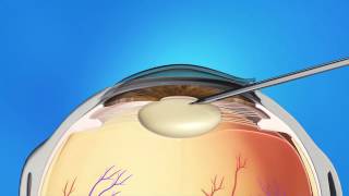 Cataract Surgery Animation [upl. by Enilatan103]