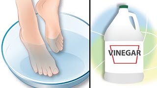 Dip Your Feet In Vinegar For This AllNatural Benefits [upl. by Gnep583]