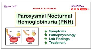 Paroxysmal Nocturnal Hemoglobinuria  PNH  SymptomsPathogenesisLab FindingsTreatment pathology [upl. by Clifton857]