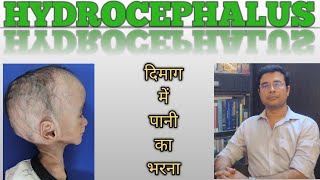 Hydrocephalus A killer disease Hindi  Symptoms amp surgeries  Dr Manish Mishra  Neurosurgeon [upl. by Eydie]