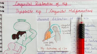 Congenital dislocation of hip part1Dysplastic hip Congenital malformation [upl. by Nnaasil]