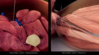Punción seca del músculo pectíneo [upl. by Mccord]