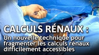 Calculs rénaux  un nouveau traitement pour les calculs difficiles à atteindre [upl. by Fernand153]