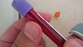 HBA1C test procedure how read HBA1C test through ichroma special biochemistry analyzer HBA1C test [upl. by Swetlana]