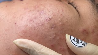 ACNE TREATMENT BO NGUYỄN  Acne On Boys Chin 2024 [upl. by Pollux]