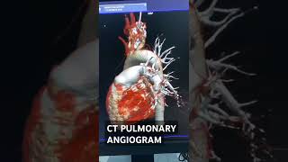 Ct pulmonary angiogram ctscan hospital viralvideo ytshorts youtubeshorts trending [upl. by Naillimxam]