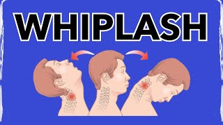 Whiplash A Physical Therapy SECRET for Treating [upl. by Annayk]