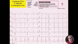 Rythme sinusal avec extrasystoles  Algorithme utile  Quiz ECG Dr Taboulet [upl. by Yarak]