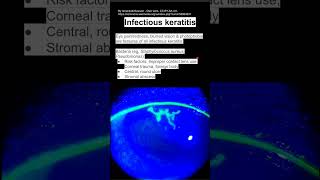 Infectious keratitis [upl. by Anavrin366]