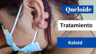 Queloide Oreja  Cicatriz Deformante  keloid [upl. by Fredette]