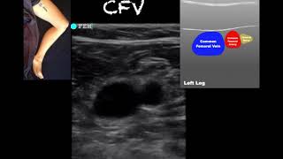 POCUS  Lower Extremity Deep Venous Thrombosis DVT  Updated [upl. by Salamone]