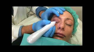 Blefaroplastia mediante láser de plasma [upl. by Howarth]