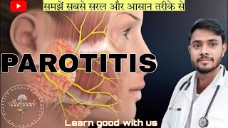 Parotitis  parotitis in hindi  paroted gland swelling  paroted gland or salivary gland infection [upl. by Moore]