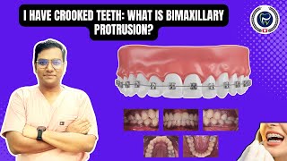 Dr Rudra Mohan  I Have Crooked Teeth What is Bimaxillary Protrusion Understand Treatment Options [upl. by Viki]