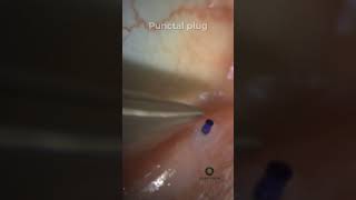 Punctal Plugs for Dry Eye [upl. by Oigolue]